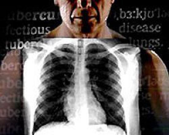 Milyonlarca kişinin ölümüne yol açan hastalıklar