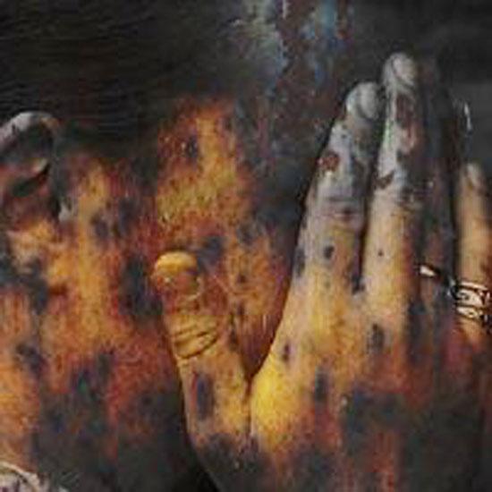 Milyonlarca kişinin ölümüne yol açan hastalıklar