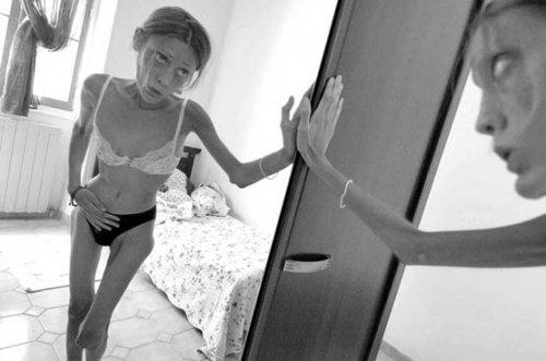 Isabelle Caro anoreksiyadan öldü