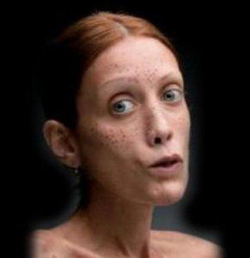 Isabelle Caro anoreksiyadan öldü