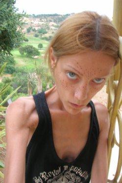 Isabelle Caro anoreksiyadan öldü