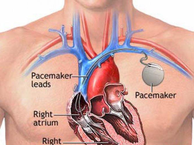 Tesadüfen bulunan icatlar