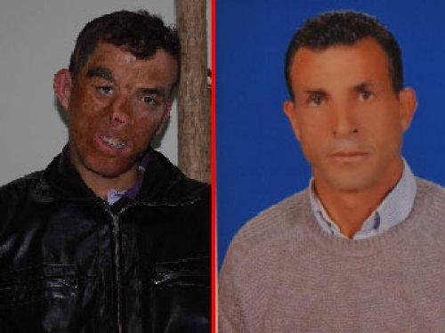 Türkiye'nin ilk yüz nakli ameliyatı - Resim 1