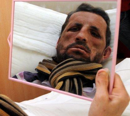 İlk yüz nakli yapılan Acar kameralar karşısında - Resim 16