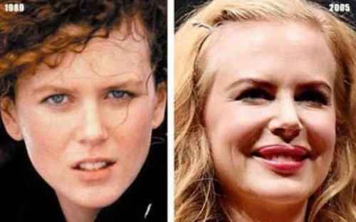 Ünlülerin estetik öncesi ve sonrası