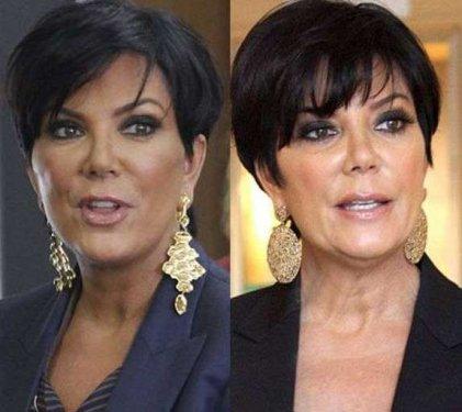 Ünlülerin estetik öncesi ve sonrası