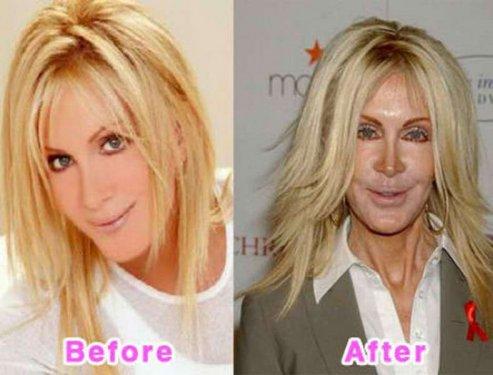 Ünlülerin estetik öncesi ve sonrası