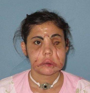 Yüz nakli olan Hatice Nergis ilk kez kameralar karşısında