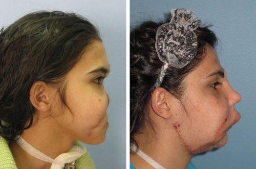 Yüz nakli olan Hatice Nergis ilk kez kameralar karşısında