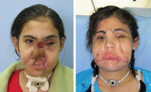 Yüz nakli olan Hatice Nergis ilk kez kameralar karşısında