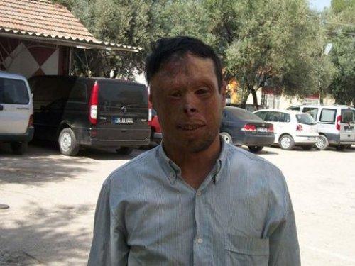 Dördüncü yüz nakli Turan Çolak'a  - Resim 9