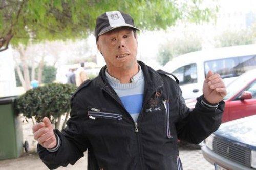 Dördüncü yüz nakli Turan Çolak'a  - Resim 8