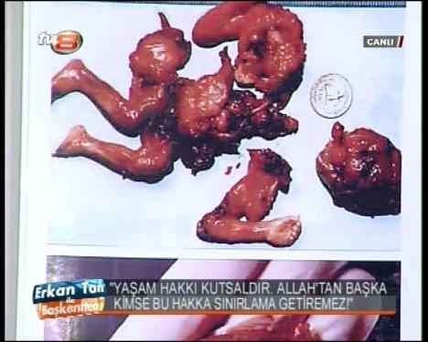 Melih Gökçek cenin fotoğrafları gösterdi