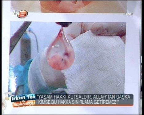 Melih Gökçek cenin fotoğrafları gösterdi