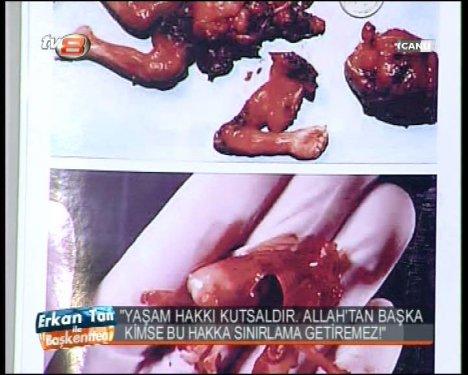 Melih Gökçek cenin fotoğrafları gösterdi