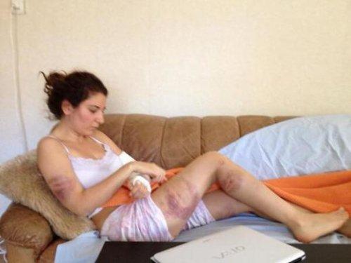 Gezi Parkı eylemcisi hastanelik oldu