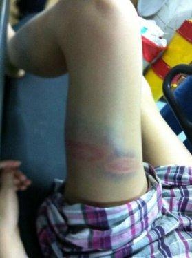 Gezi Parkı eylemcisi hastanelik oldu