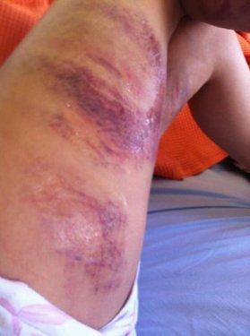 Gezi Parkı eylemcisi hastanelik oldu