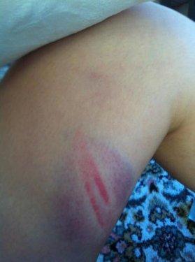 Gezi Parkı eylemcisi hastanelik oldu