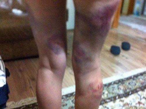 Gezi Parkı eylemcisi hastanelik oldu