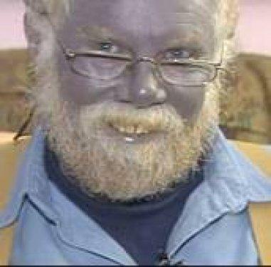 Dünyadaki en garip hastalıklar