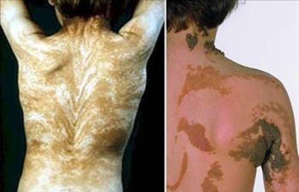 Dünyadaki en garip hastalıklar