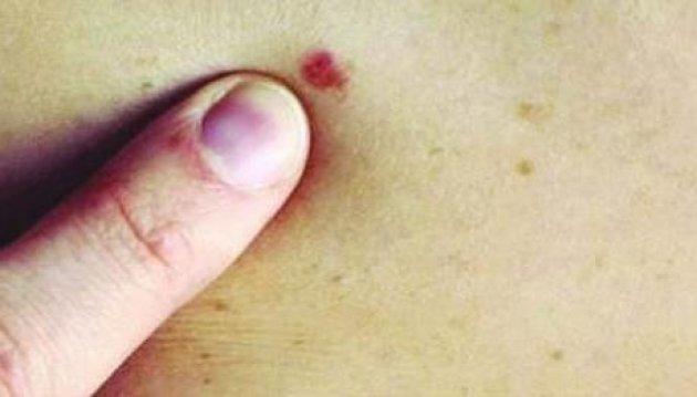 Kanserli ben nasıl anlaşılır