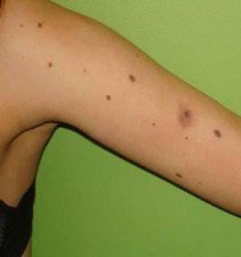 Kanserli ben nasıl anlaşılır