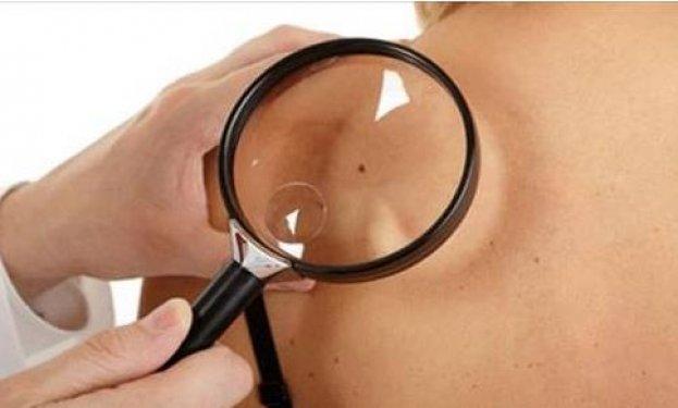 Kanserli ben nasıl anlaşılır