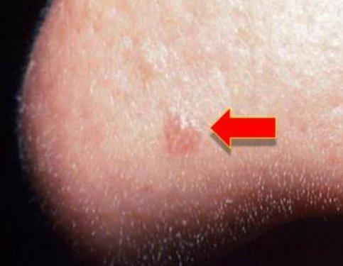 Kanserli ben nasıl anlaşılır