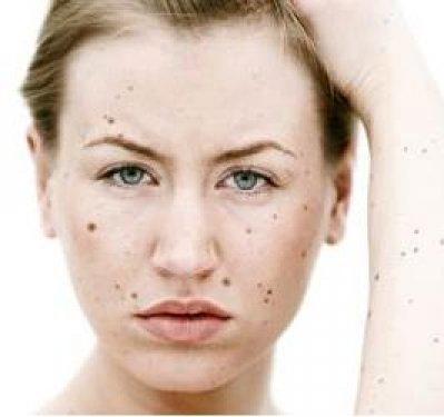 Kanserli ben nasıl anlaşılır