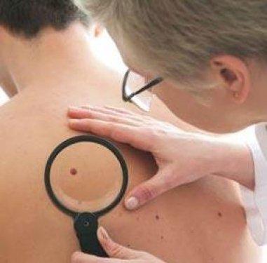 Kanserli ben nasıl anlaşılır