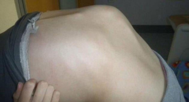 Eğri omurlu bu kız  manken oldu