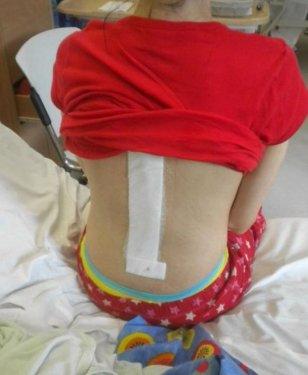 Eğri omurlu bu kız  manken oldu