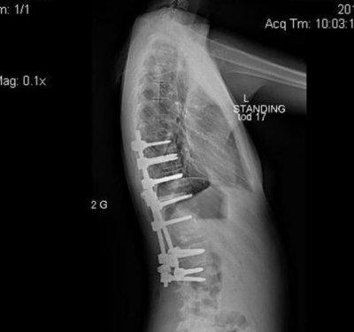Eğri omurlu bu kız  manken oldu