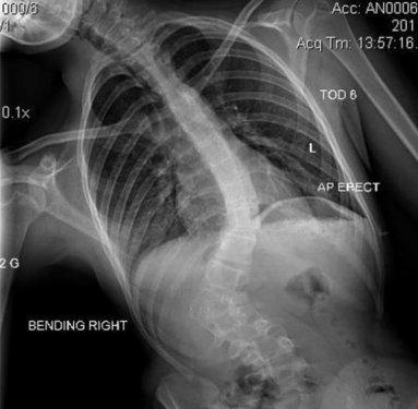 Eğri omurlu bu kız  manken oldu