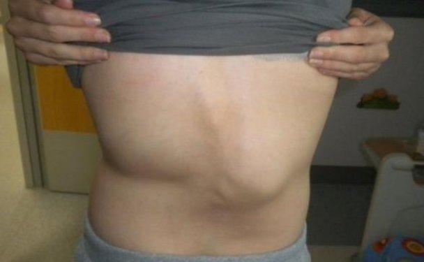 Eğri omurlu bu kız  manken oldu