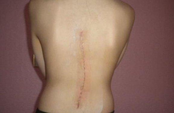 Eğri omurlu bu kız  manken oldu