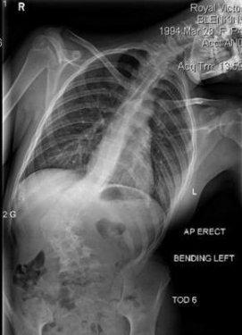 Eğri omurlu bu kız  manken oldu