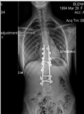 Eğri omurlu bu kız  manken oldu