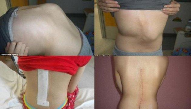 Eğri omurlu bu kız  manken oldu