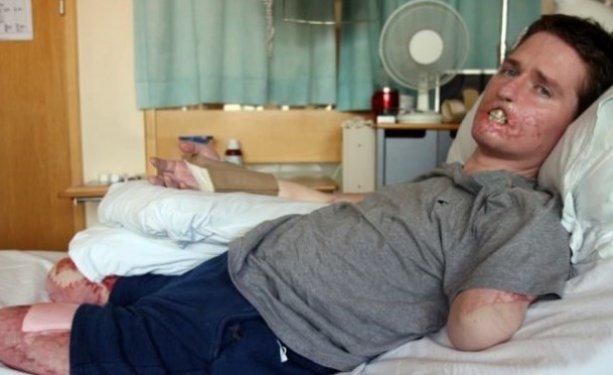 Et yiyen bakteri 4ay da bu hale getirdi