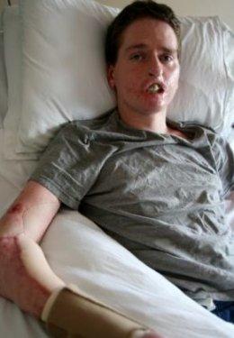 Et yiyen bakteri 4ay da bu hale getirdi