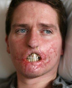 Et yiyen bakteri 4ay da bu hale getirdi