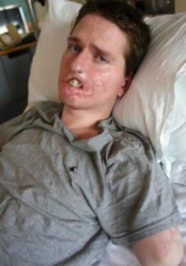 Et yiyen bakteri 4ay da bu hale getirdi