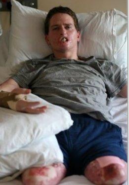 Et yiyen bakteri 4ay da bu hale getirdi