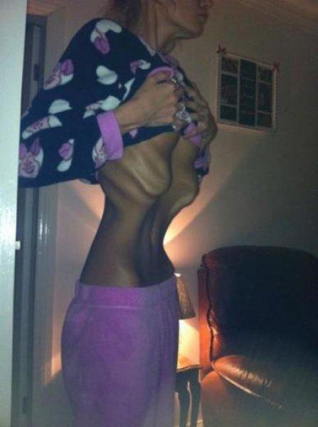 Beth Cowan Anoreksiya'ya karşı savaşını kazandı 