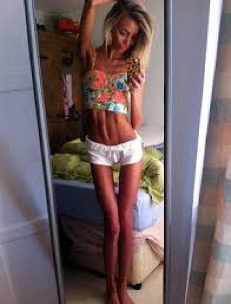 Beth Cowan Anoreksiya'ya karşı savaşını kazandı 