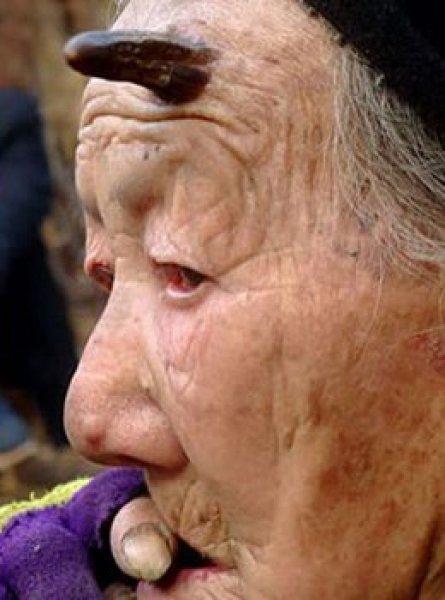 Dünyadaki en ilginç hastalıklar