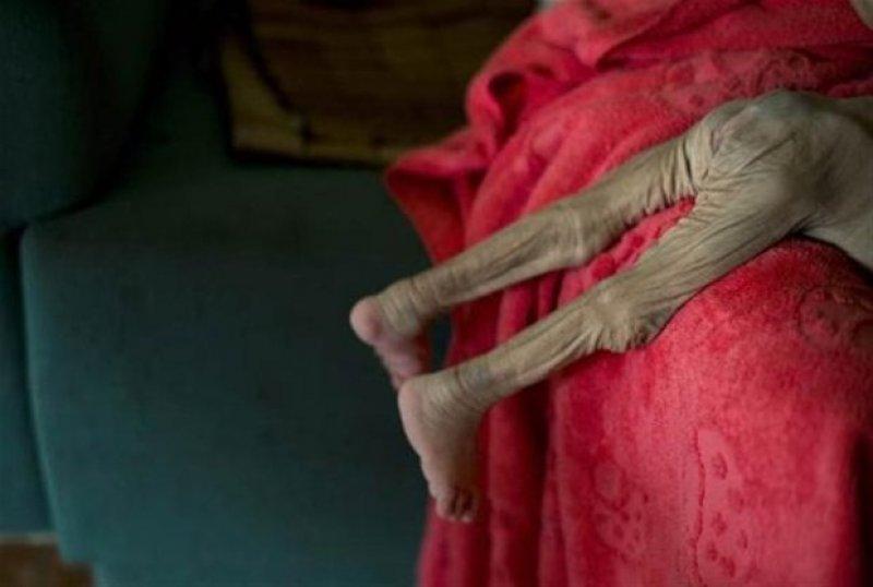 Dünyadaki en ilginç hastalıklar